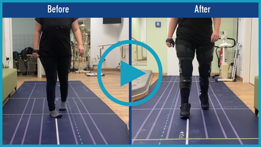 Patient video of a patient with herediary ataxia. Before and after comparison of the gait without a medical device and with a custom-made knee-ankle-foot orthosis KAFO with NEURO VARIO-SWING system knee joint with significantly more safety when walking and standing.